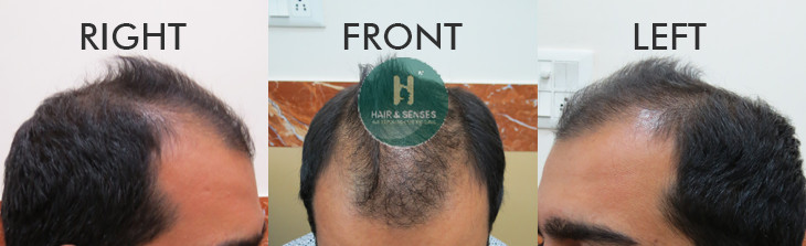 Before Procedure 3096
